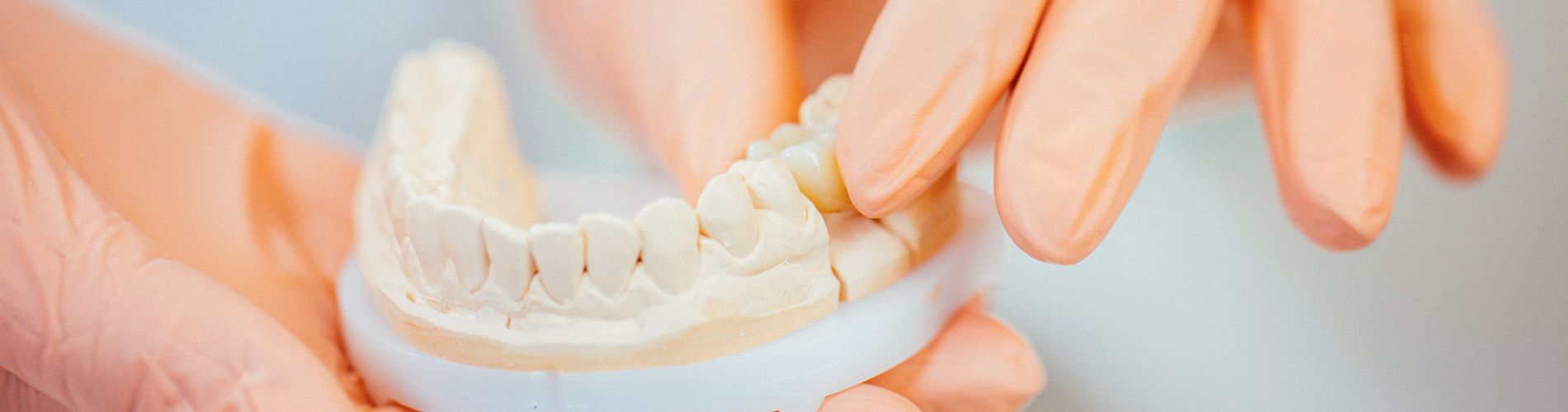 Implant Supported Dentures - Alvaro Ordonez