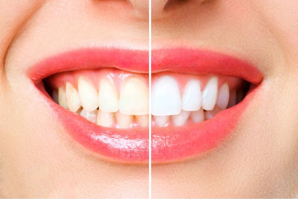 Teeth Whitening - Alvaro Ordonez